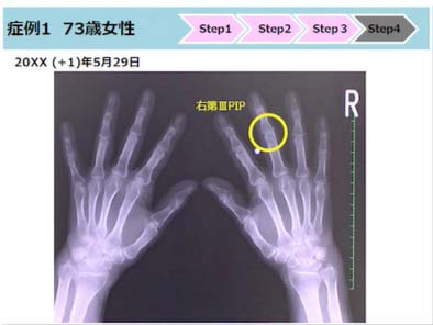 第2部:リウマチ治療薬が選択されるまでの過程