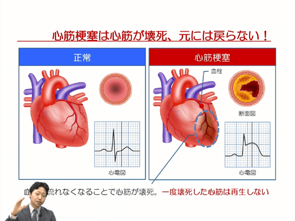 第3部:虚血性心疾患