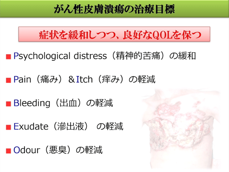 第2部:乳癌のがん性皮膚潰瘍の治療と薬剤師の役割(1)