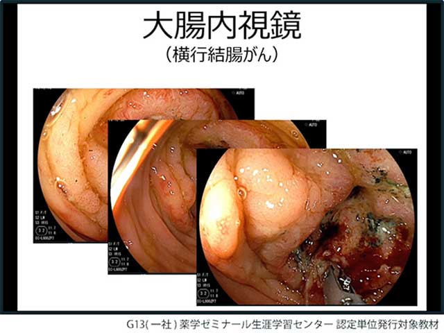 薬薬連携で支える「外来がん薬物療法」の画像
