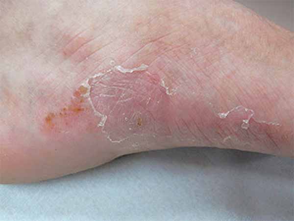 人から人へどのように伝染するのか