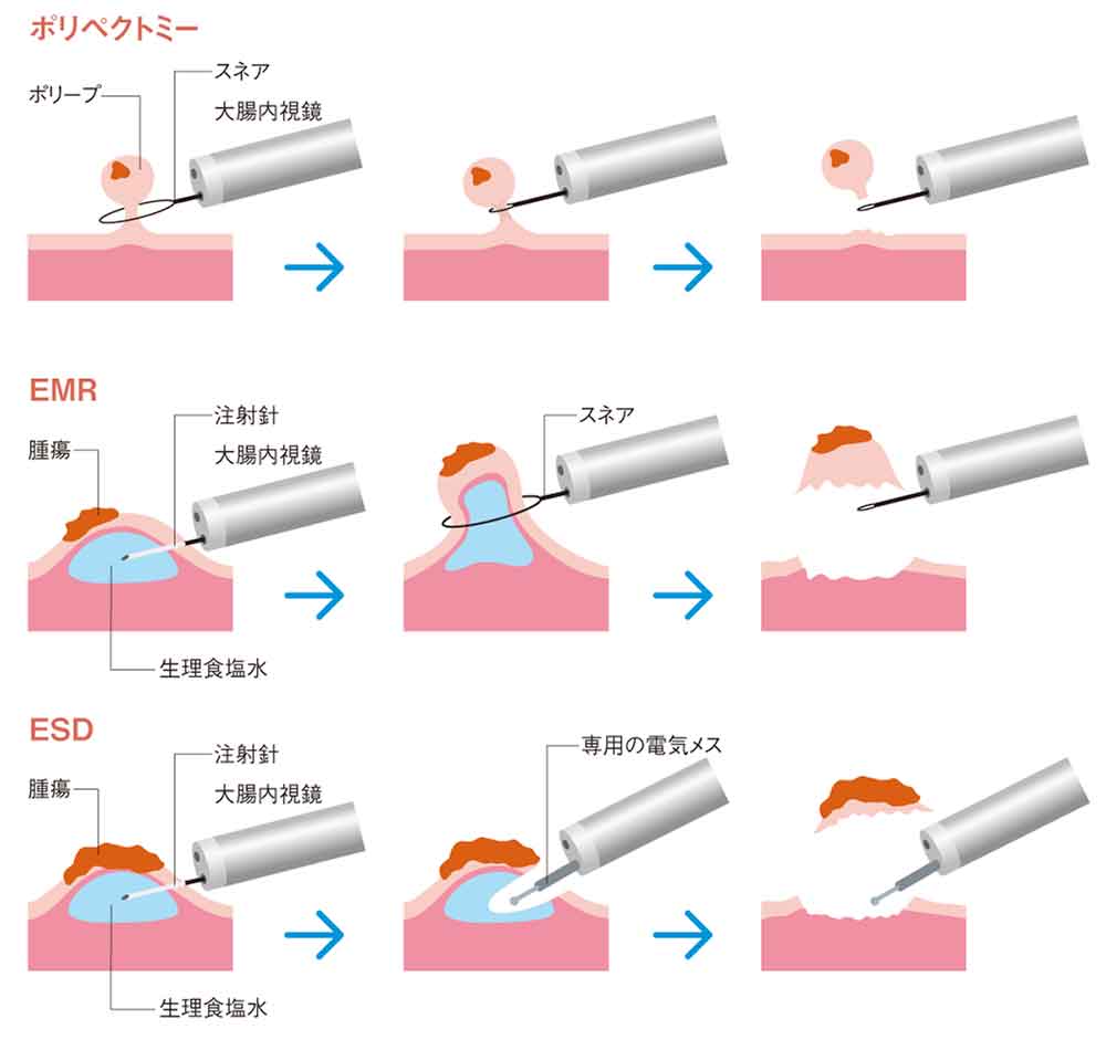 内視鏡治療の方法の画像